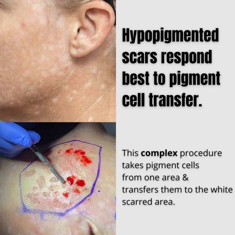 Best Hypopigmented Scars Treatment In Brisbane Dr Davin Lim