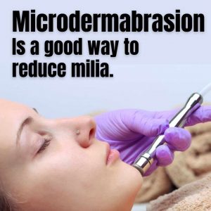 milia-microdermabarasion