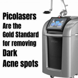 Acne Scars Hyperpigmentation, pico laser acne scars