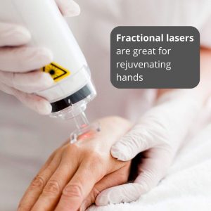 fractional-laser-hands