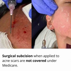 subcision-medicare