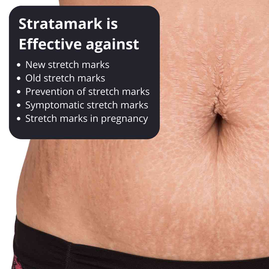 Best Stretchmarks Treatments In Australia Dr Davin Lim