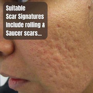 acne-scar-types-profhilo
