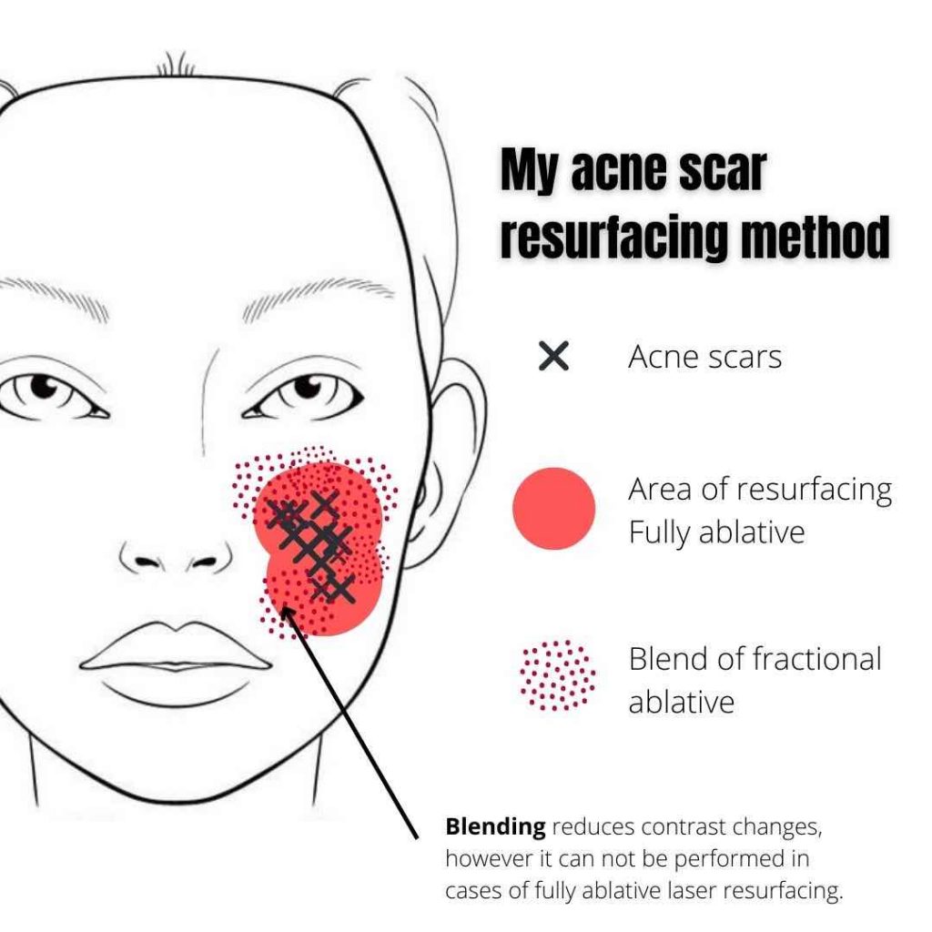 Acne Scars; Medicare & Costs Dr Davin Lim