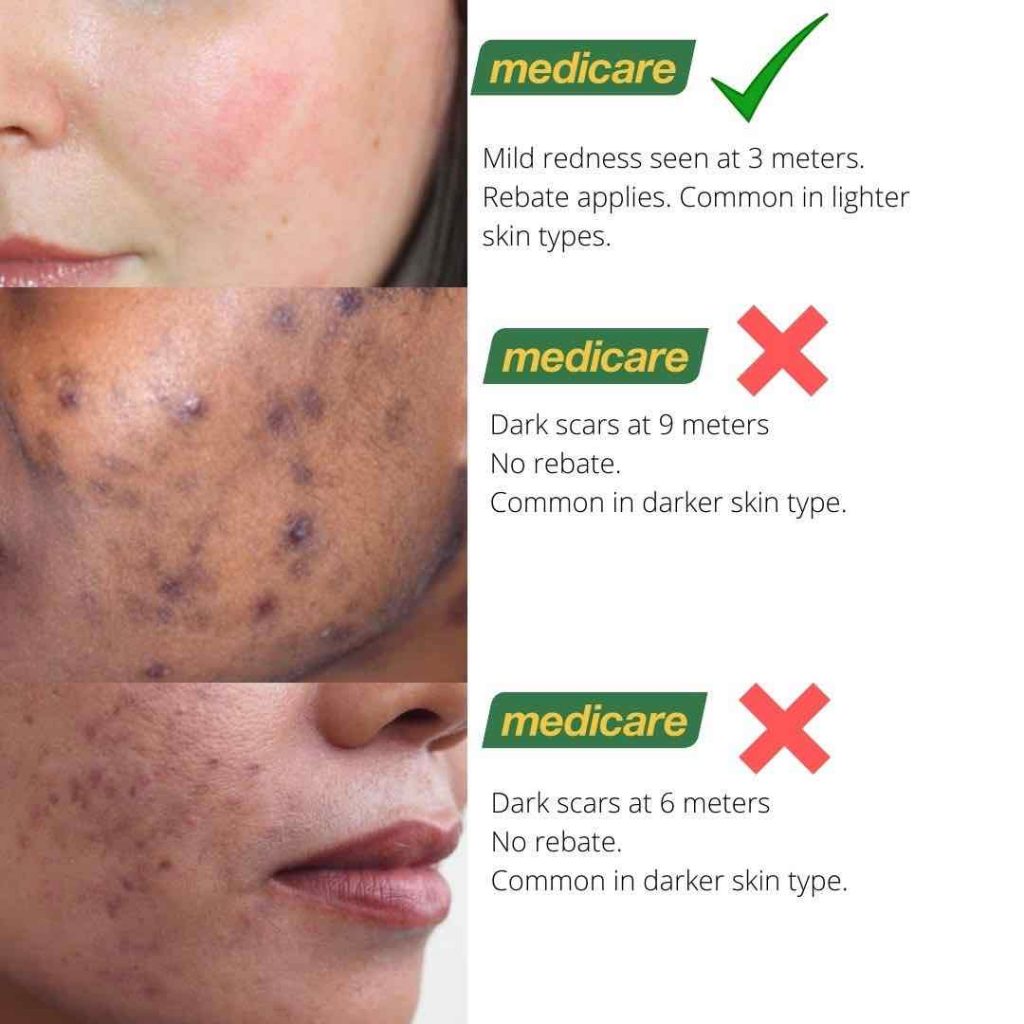 Acne Scars; Medicare & Costs Dr Davin Lim