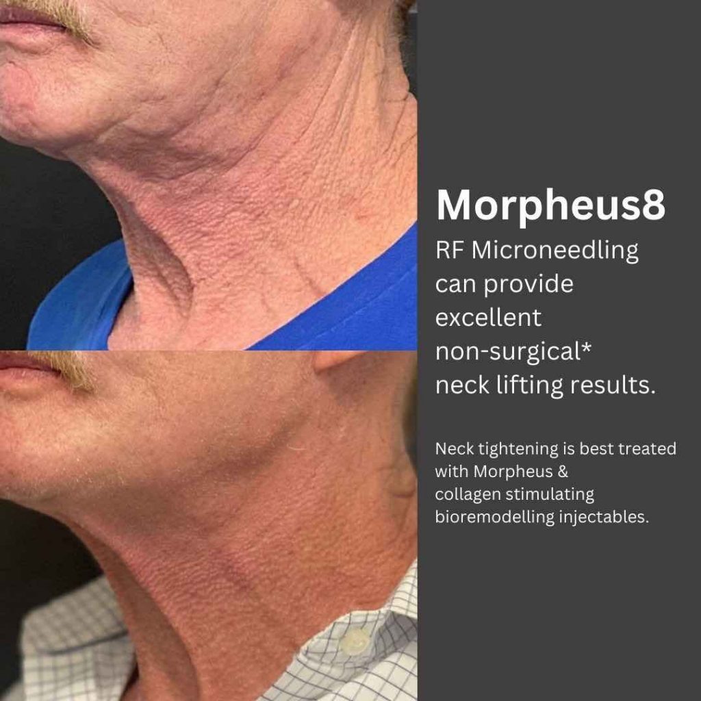 Best Morpheus 8 RF Microneedling In Brisbane Dr Davin Lim