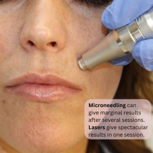 microneedling-lip-wrinkles