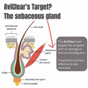 aviclear-acne-treatment