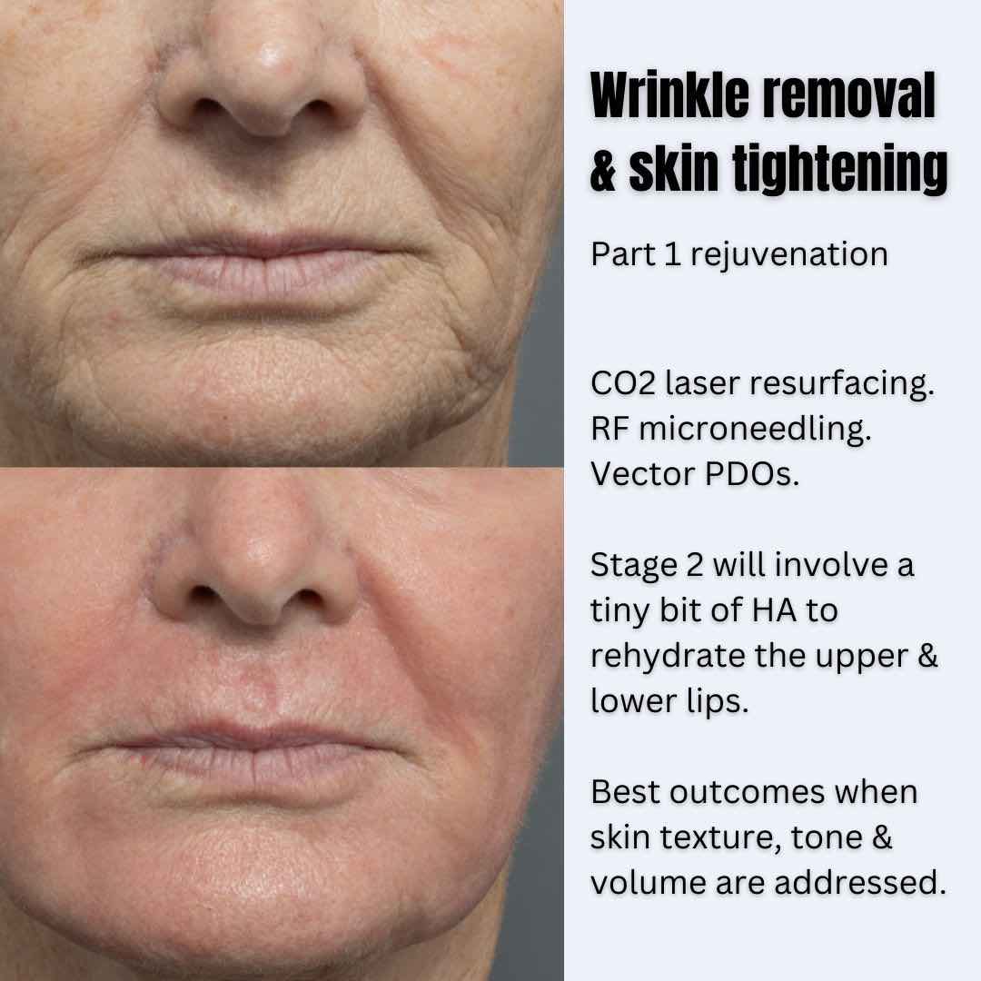 co2-lip-wrinkle-treatment