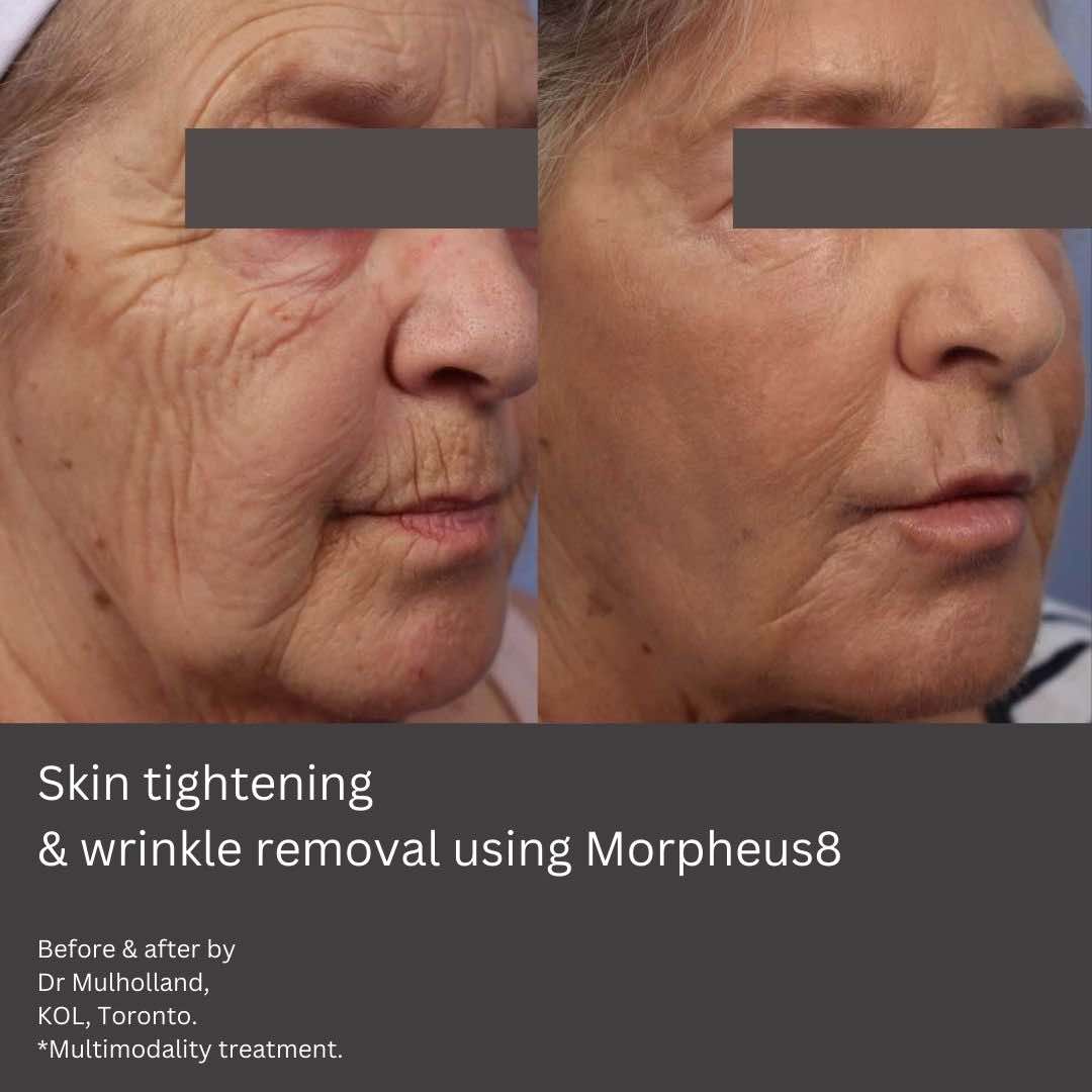 skin-tightening-morpheus