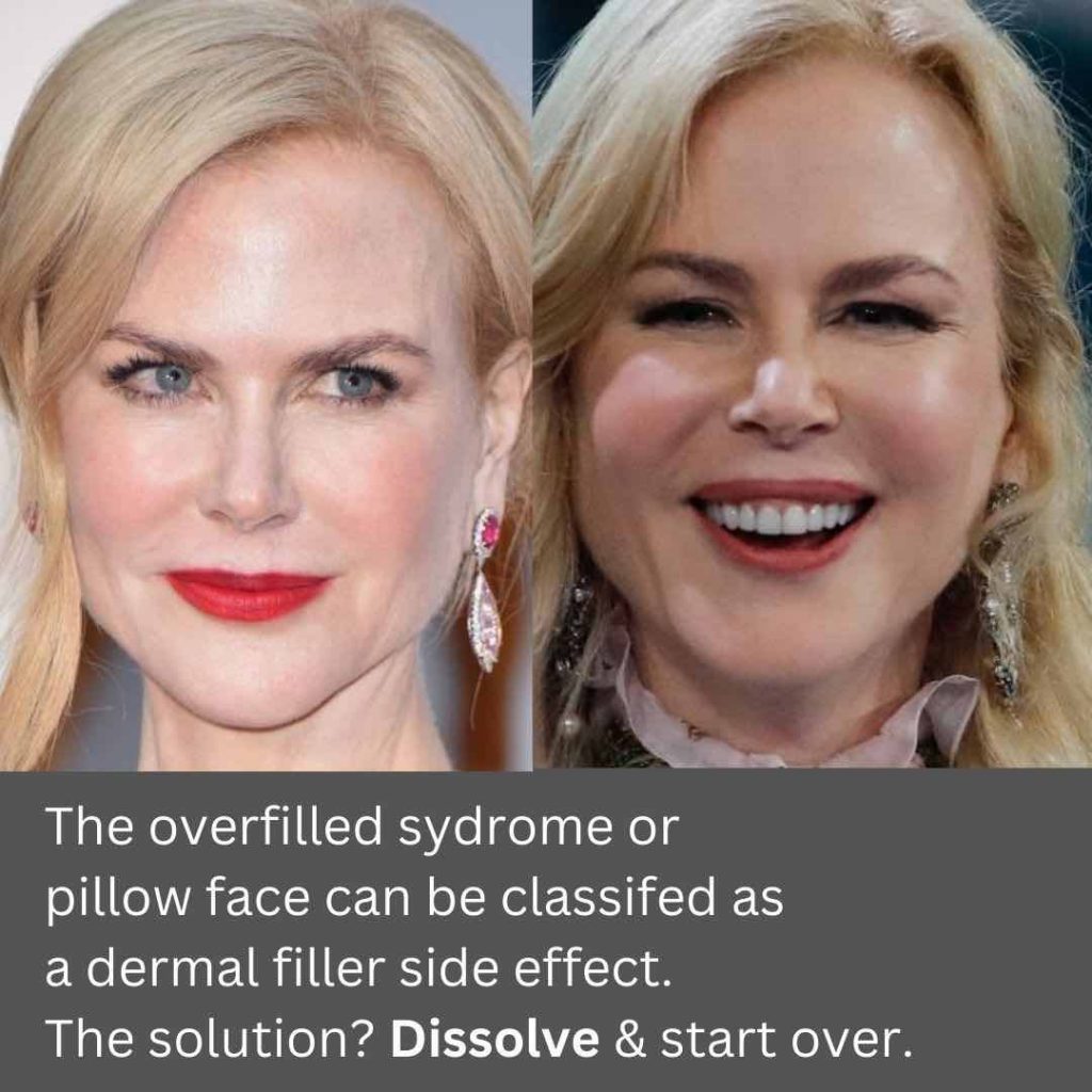 Dermal Fillers, Side Effects Dr Davin Lim