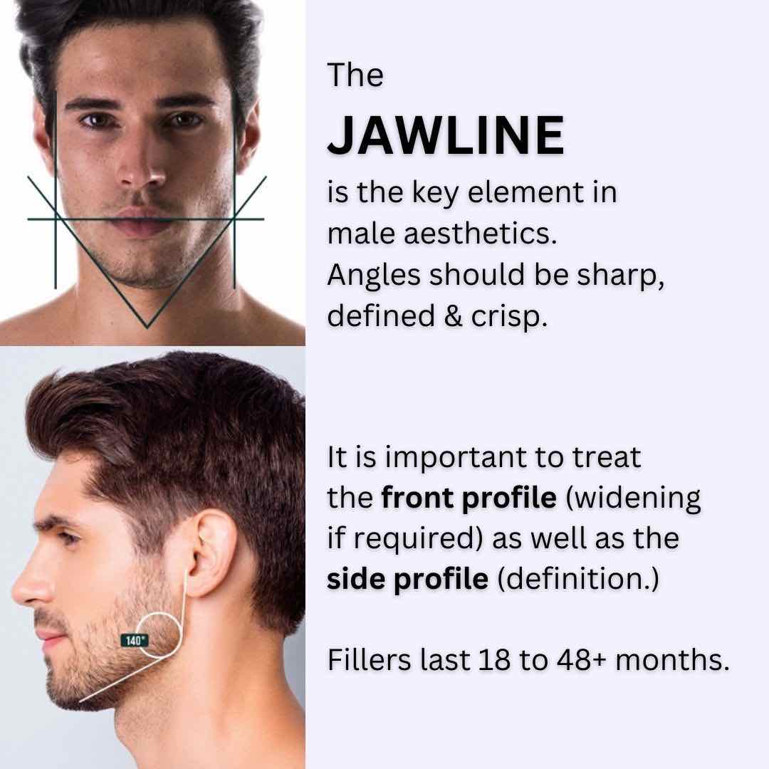 jaw-fillers-males