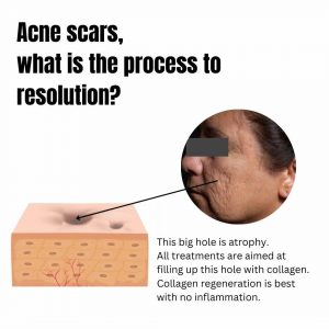 atrophic-acne-scars