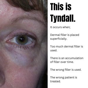 Tyndall-removal