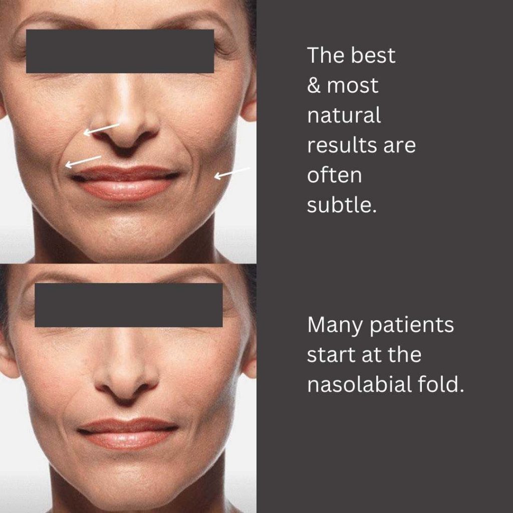 Best Nasolabial Fold Treatments In Australia Dr Davin Lim