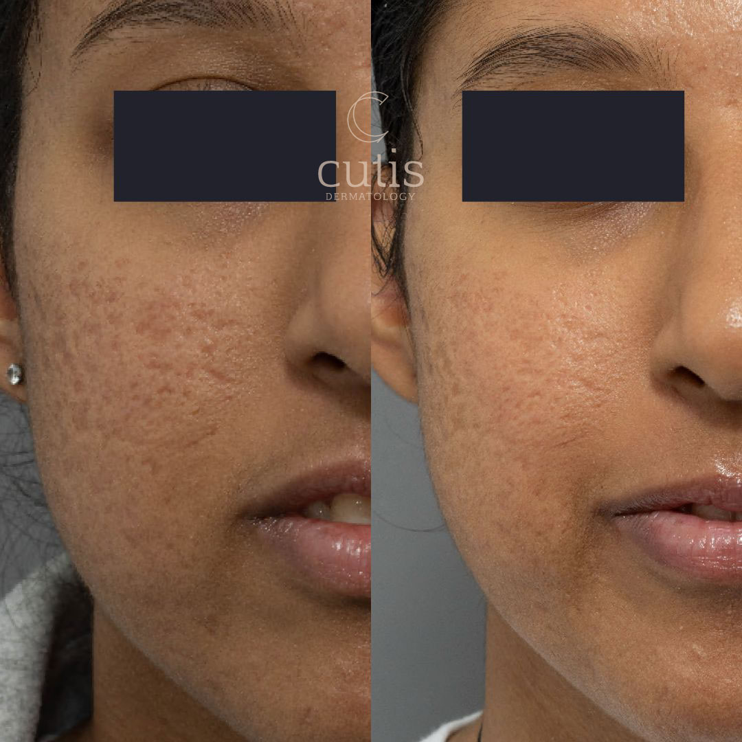 Acne scar laser treatment for ethnic skin