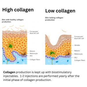 biostimulator collagen stimulation