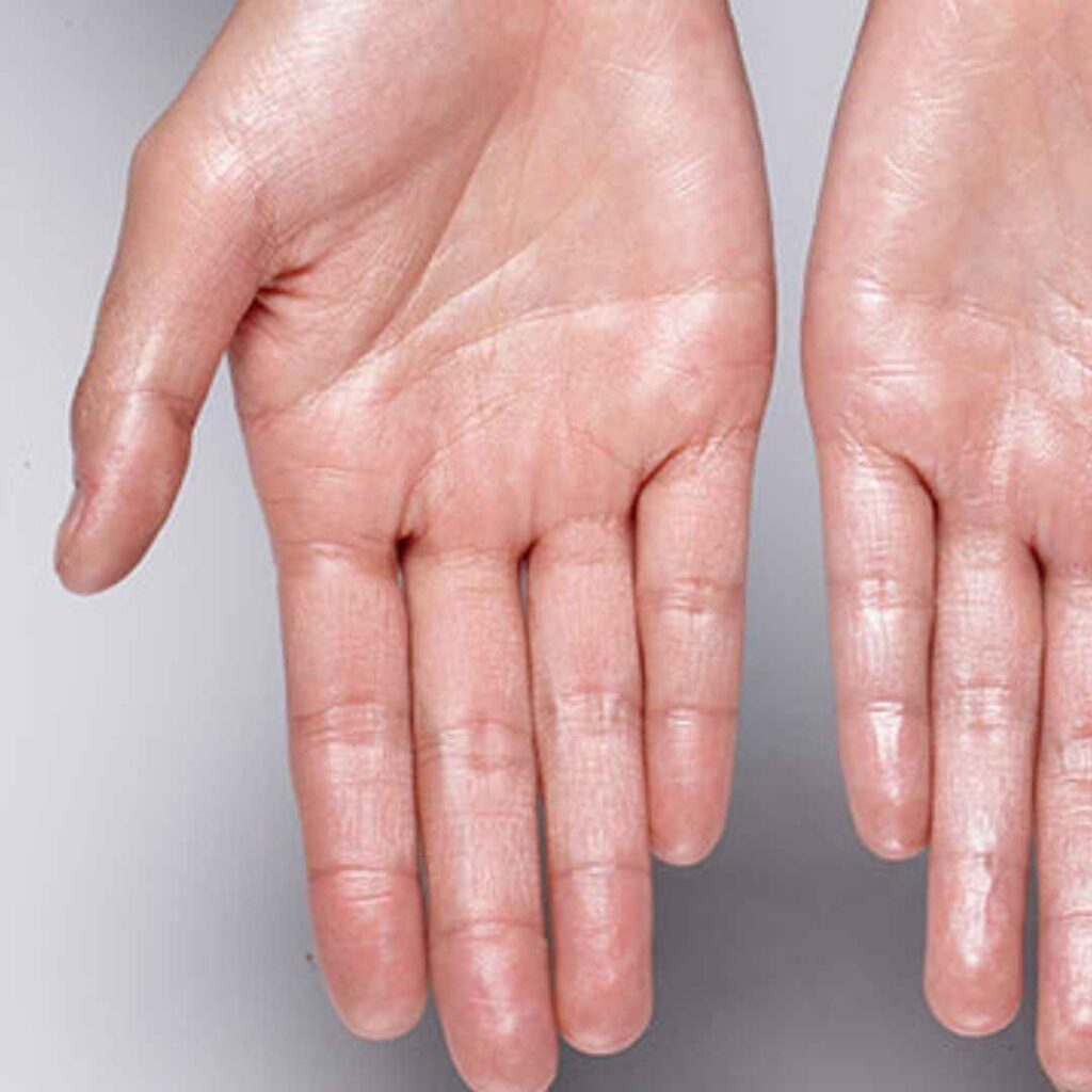 how to treat sweaty hands
