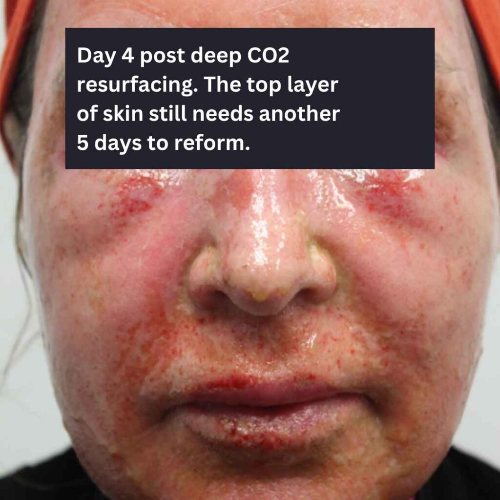 Co2 laser recovery 1