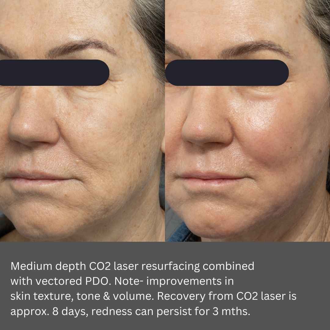 Best CO2 Laser Resurfacing Near Me Dr Davin Lim
