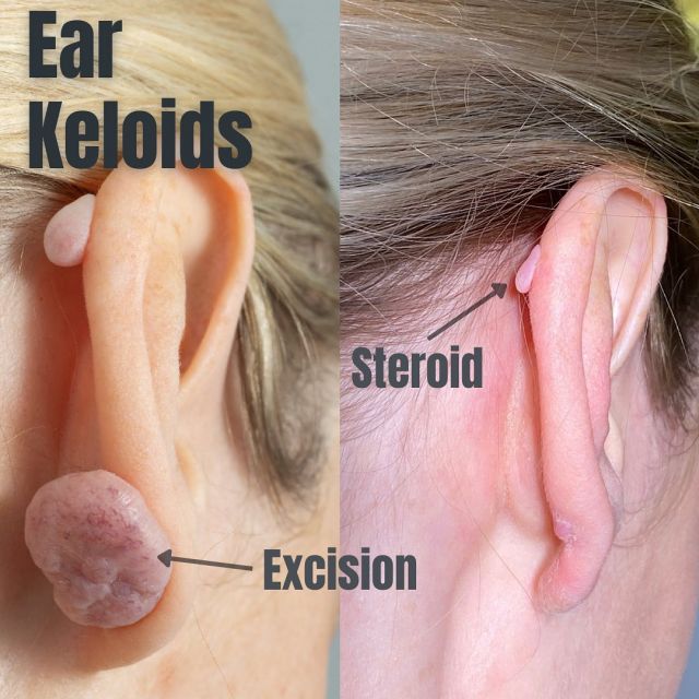 Ear keloid Custom Acrylic Compression - Pressure Earring, Made to Fit,  Flatten Keloid, Scar Management, Ear Scar Management